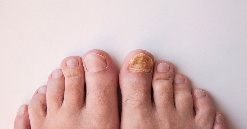 What Causes Thick Toenails and How Can You Treat Them?