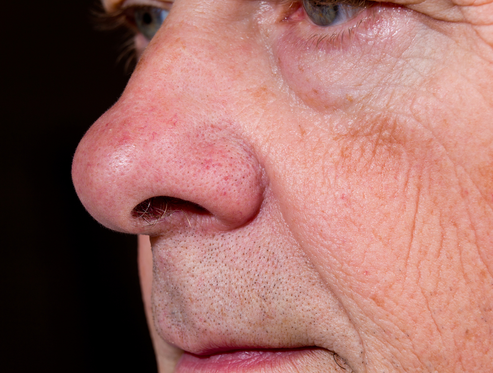 Side view of mature man's nose and upper lip with the eyes just visible
