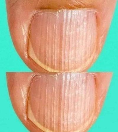 Having Striped Nails Could Mean That Your Body Is… More Details below